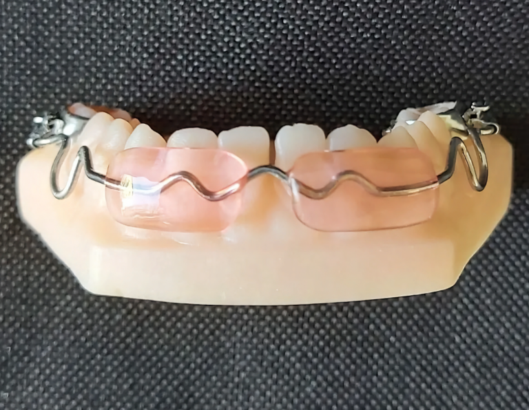 Lip Bumper Amovible Laboratoire Dentaire ORTHODESIGN Sarl